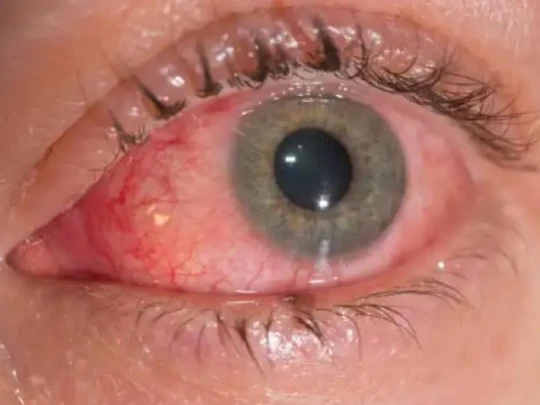 Medicina Oftalmologia Doenças Oculares Externas